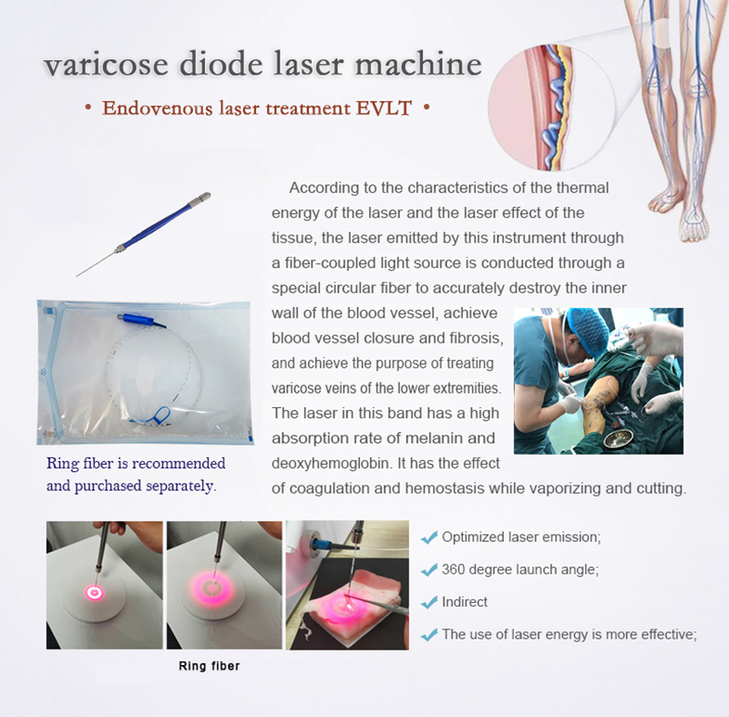 Varicose-vein-details